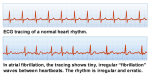 REV3-ECG-AFIB-Heart-Rhythm-for-A-Fib.com-500-pix-by-96-res.png